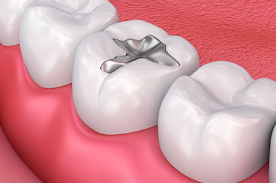 The image shows a close-up view of a human mouth with an orthodontic appliance, specifically a bracket, attached to one of the teeth, which appears to be a molar, and gum tissue in shades of pink and red.