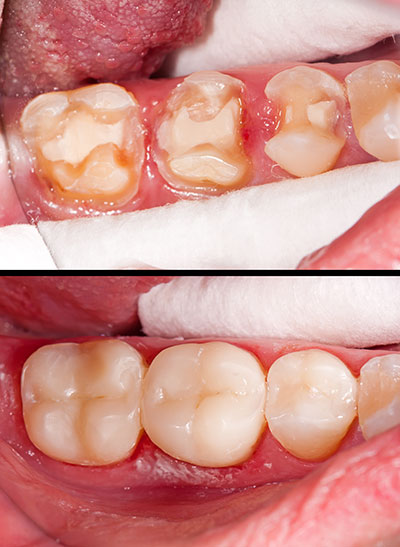 The image shows a close-up view of a person s mouth with teeth that are yellowed and discolored, possibly due to staining or decay, which may require dental treatment such as cleaning or restoration.