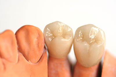 The image displays two rows of artificial teeth placed side by side against a white background, showcasing their design and structure.