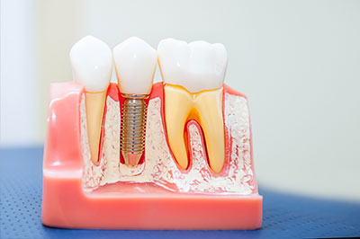 The image displays a dental model with artificial teeth and gums, showcasing a close-up view of teeth with visible fillings and a single tooth with an implant screwed into it.