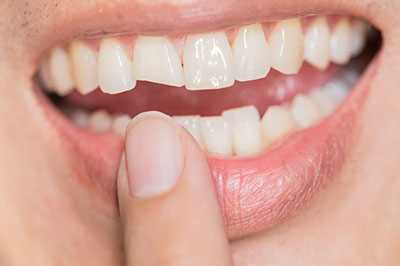 The image shows a person with a large smile revealing teeth, holding their finger on their lip, seemingly in the process of examining or feeling their teeth.