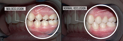 The image shows a side-by-side comparison of a person s teeth before and after dental treatment, highlighting the improvement with  Malocclusion  labeled on the left and  Normal occlusion  labeled on the right.