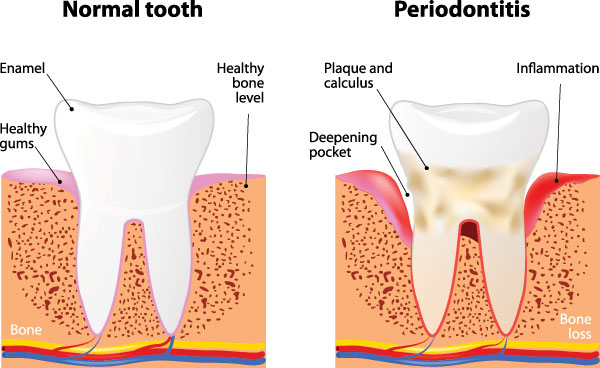 The image displays a diagrammatic representation of teeth with labels indicating normal tooth structure and stages of periodontitis, including bone loss around the teeth.