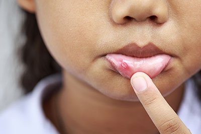 The image shows a child s face with acne, and they are pointing at their skin with their finger.