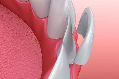 This image depicts a close-up view of a dental implant with a metallic screw visible on its surface, set against a pink background that resembles gum tissue.