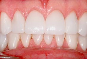 The image shows a close-up view of someone s teeth with white fillings, highlighting dental work done on the upper front teeth.