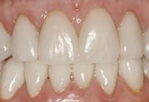 The image shows a close-up view of a person s teeth, with a focus on the lower front teeth which appear to be discolored or stained.