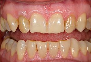 An extreme close-up of a mouth with teeth showing signs of decay and staining, against a blurred background.