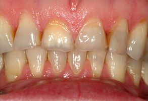 The image shows a close-up view of a person s teeth with visible yellowing and staining, suggesting poor oral hygiene or dental issues.